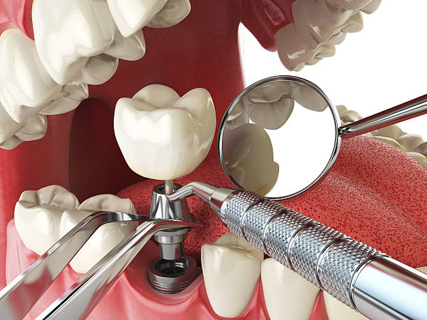 Best Broken or Cracked Tooth Emergency Dentist in Woodworth, OH